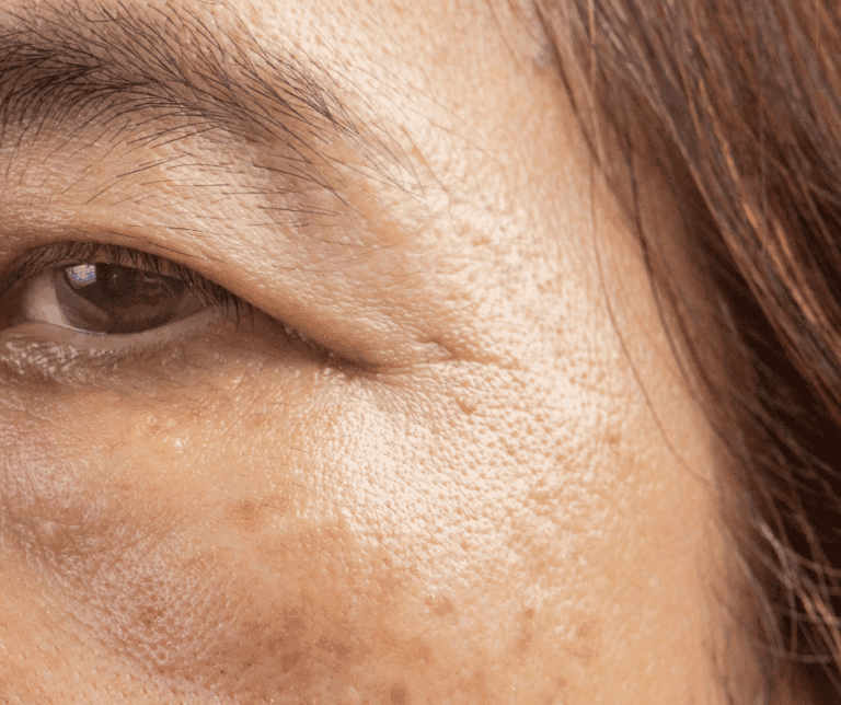 Age Spots: Effective Treatments for Senior Skin